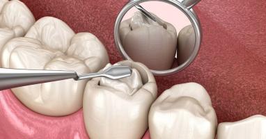 Địa chỉ trám răng uy tín nhất tỉnh Ninh Bình