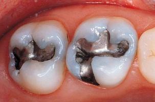 Địa chỉ trám răng uy tín nhất TP. Huế, Thừa Thiên Huế
