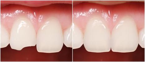 Địa chỉ trám răng uy tín nhất tỉnh Bắc Giang