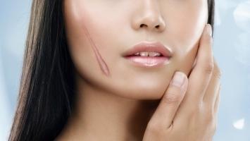 Cách trị sẹo hiệu quả nhất bằng phương pháp tự nhiên