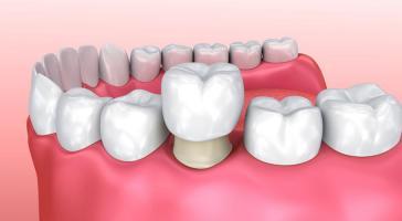 Địa chỉ tẩy trắng răng uy tín nhất TP. Nha Trang, Khánh Hòa
