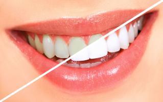 Địa chỉ tẩy trắng răng uy tín hàng đầu tại Hải Phòng