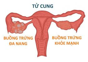 Địa chỉ khám và điều trị buồng trứng đa nang uy tín nhất TP. Hồ Chí Minh