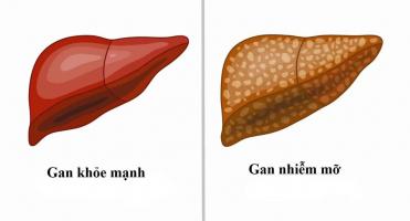 Địa chỉ khám và điều trị gan nhiễm mỡ tốt nhất Hà Nội