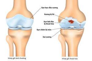 Địa chỉ khám và điều trị thoái hóa khớp tốt nhất Hà Nội