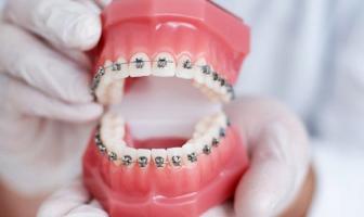 Địa chỉ niềng răng uy tín nhất tại Vĩnh Long