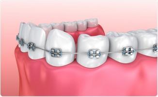 Địa chỉ niềng răng uy tín nhất Đà Nẵng