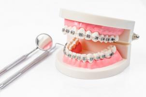 Địa chỉ niềng răng uy tín nhất TP. Long Xuyên, An Giang