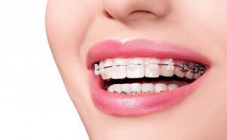 Địa chỉ niềng răng uy tín nhất TP. Vinh, Nghệ An