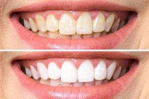 Địa chỉ tẩy trắng răng chất lượng, uy tín nhất tại Bình Dương