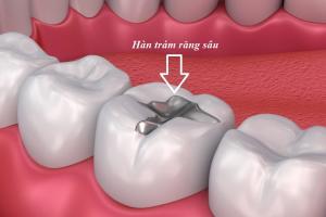 Địa chỉ trám răng uy tín nhất tỉnh Lạng Sơn
