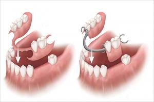 Lưu ý quan trọng nhất về răng giả tháo lắp