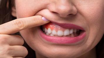 Lưu ý quan trọng nhất về sưng nướu chân răng