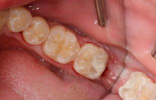 Địa chỉ trám răng uy tín nhất Thanh Hóa