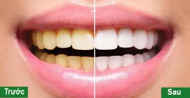 Địa chỉ tẩy trắng răng uy tín nhất TP. Đồng Hới, Quảng Bình