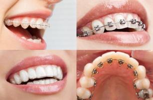 Địa chỉ niềng răng uy tín tốt nhất tại Hải Phòng