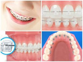 Địa chỉ niềng răng uy tín nhất tại Huế