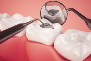 Địa chỉ trám răng uy tín nhất TP. Vinh, Nghệ An