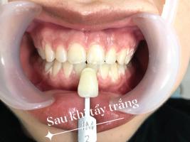 Địa chỉ tẩy trắng răng uy tín nhất tỉnh Hà Tĩnh