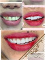 Địa chỉ tẩy trắng răng uy tín nhất TP. Thủ Dầu Một, Bình Dương