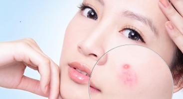 Spa trị mụn hiệu quả nhất Vũng Tàu