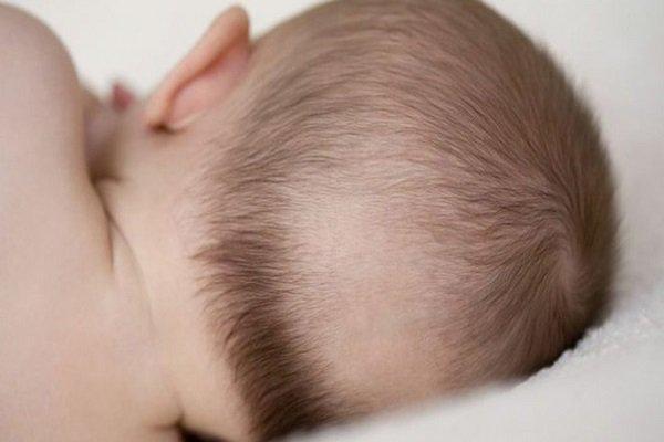Hiện tượng bé rụng tóc hình vành khăn