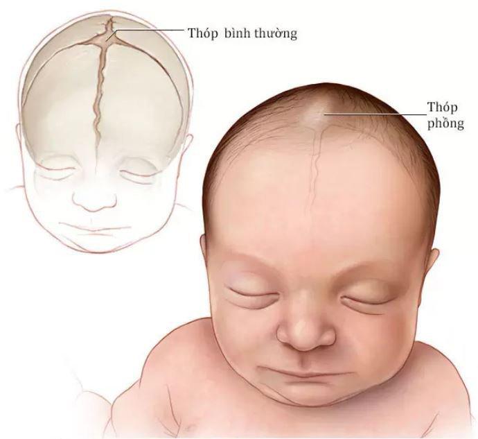 Thóp liền quá muộn