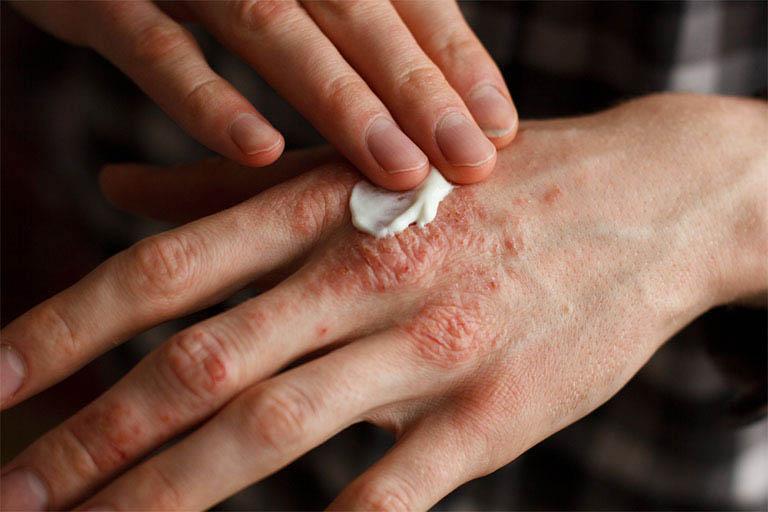 Viêm da cơ địa có nguy hiểm không?