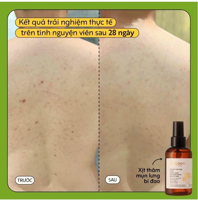 Xịt giảm mụn và thâm mụn lưng bí đao Cocoon